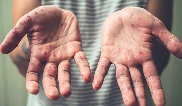 فيروس يسمى HFMD