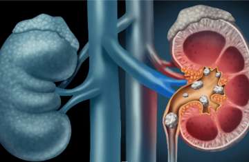  أداة بالذكاء الاصطناعي للكشف المبكر عن سرطان الكلى