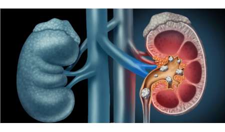 تطوير أداة بالذكاء الاصطناعي للكشف المبكر عن سرطان الكلى