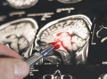 اكتشاف روسي جديد يفتح الطريق لتطوير أدوية لعلاج باركنسون