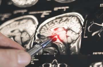 اكتشاف روسي جديد يفتح الطريق لتطوير أدوية لعلاج باركنسون