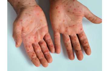 Measles